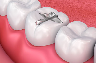 Thomas Fitzsimmons, DDS | Crowns  amp  Caps, Dental Fillings and Preventative Program