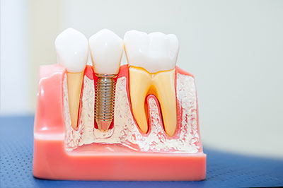 Thomas Fitzsimmons, DDS | Crowns  amp  Caps, Dental Fillings and Veneers