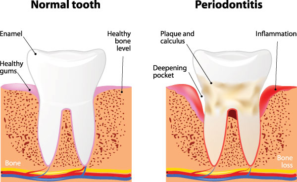 Thomas Fitzsimmons, DDS | Preventative Program, Dental Fillings and Teeth Whitening