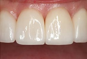 Thomas Fitzsimmons, DDS | Crowns  amp  Caps, Digital Radiography and Teeth Whitening