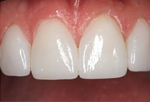 Thomas Fitzsimmons, DDS | Periodontal Treatment, Veneers and Dental Fillings