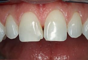 Thomas Fitzsimmons, DDS | Dental Bridges, Periodontal Treatment and Root Canals
